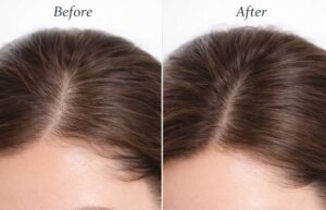 Dermaroller for Hair Growth Safety Tips You Need to Know