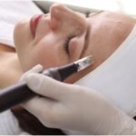 Microneedling in Canberra: Revolutionising Skin Rejuvenation