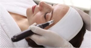 Microneedling in Canberra: Revolutionising Skin Rejuvenation