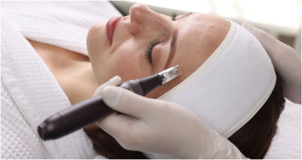 Microneedling in Canberra: Revolutionising Skin Rejuvenation