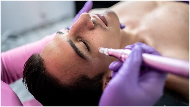The Science Behind Microneedling